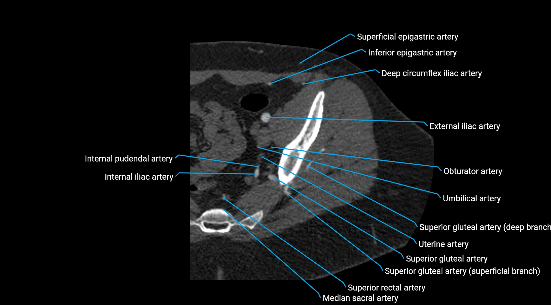 CTA lower limb cross sectional anatomy labelled image _35.webp